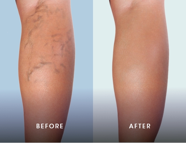 varicose veins results - 1 before after