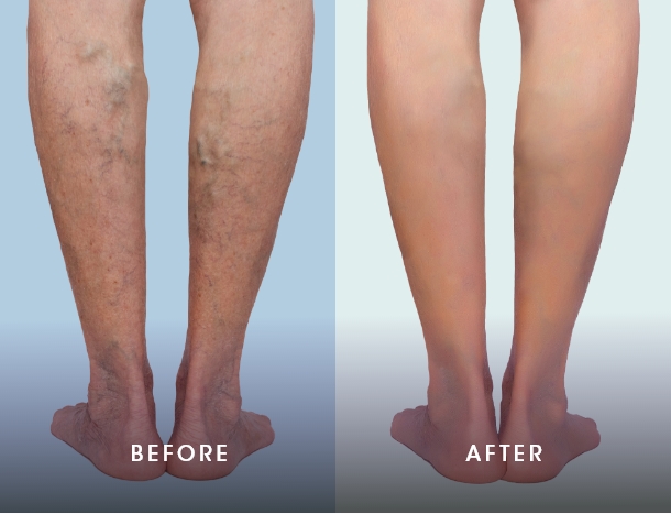 varicose veins results - 3 before after