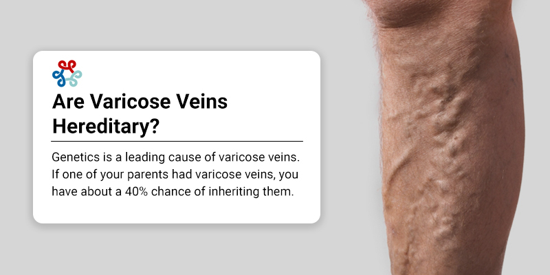 Are Varicose Veins Hereditary?