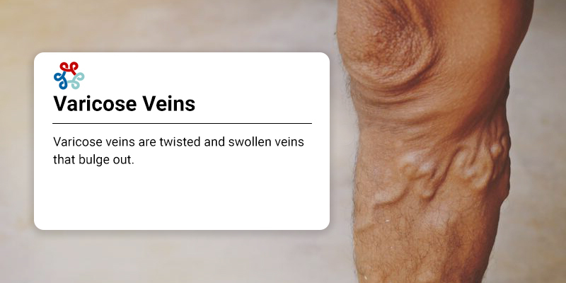 Varicose veins