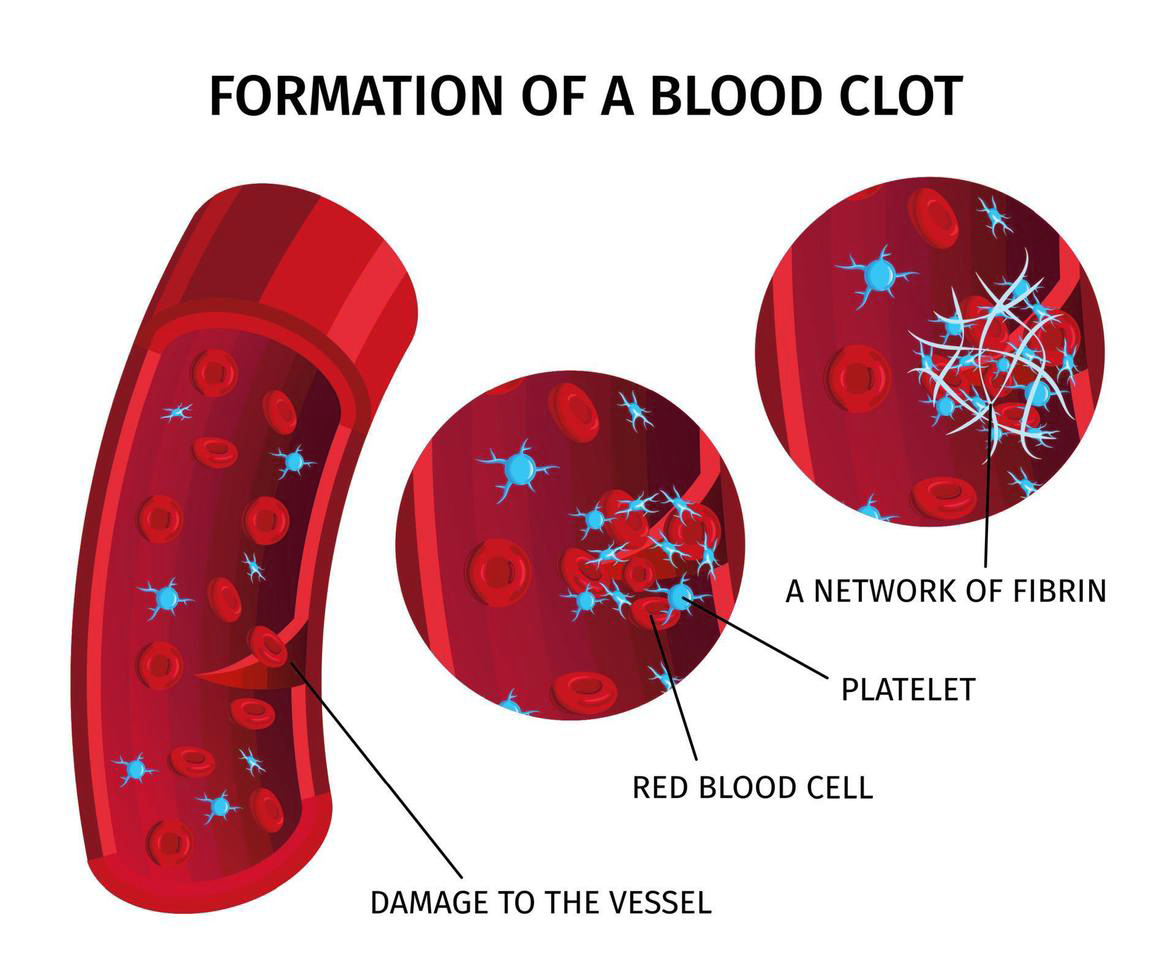 Blood Clot