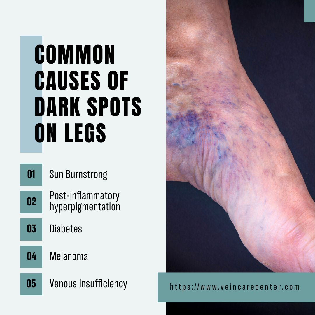 What Are White Spots On Legs