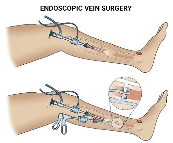 Endoscopic Vein Surgery