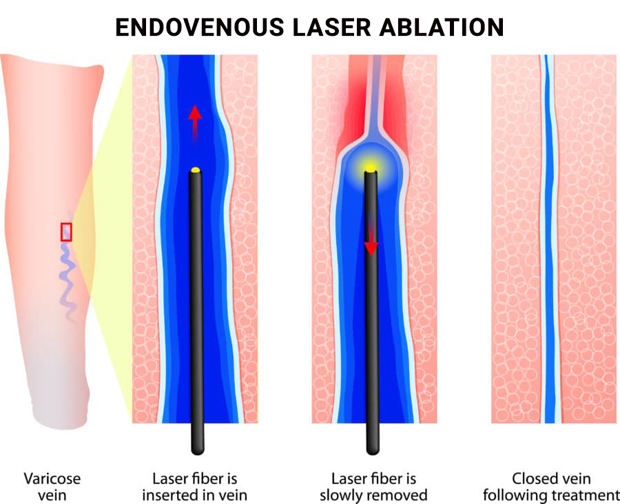 Endovenous Laser Ablation