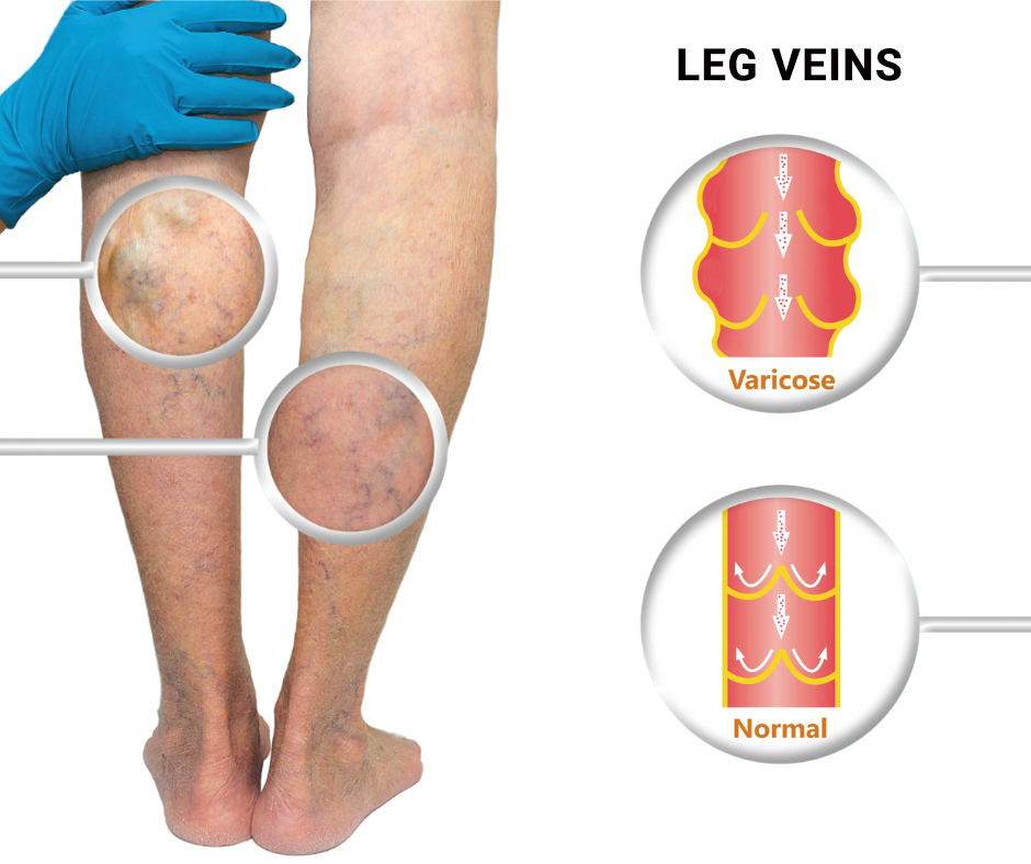 Leg Veins