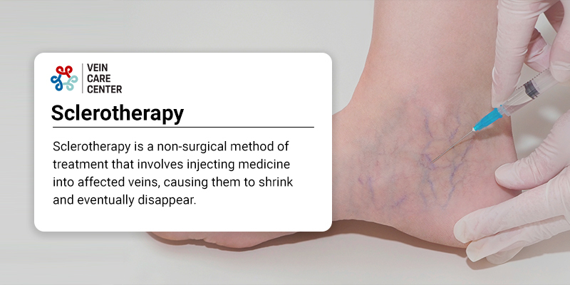 Sclerotherapy for Spider Veins