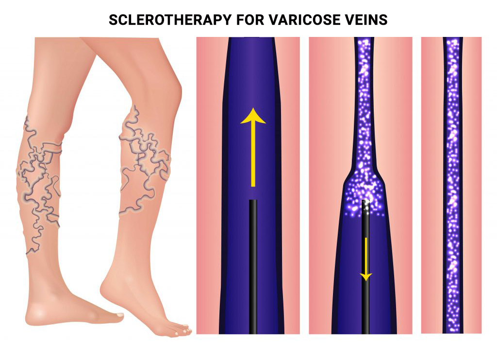 Sclerotherapy for Varicose Veins