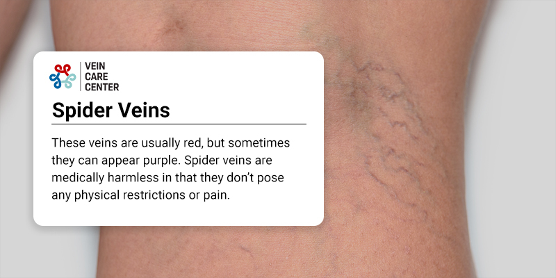 Spider Veins