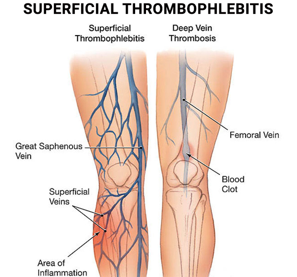 Superficial Thrombophlebitis